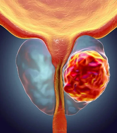 Cáncer de próstata urólogo Dr. Orlando José Hernández