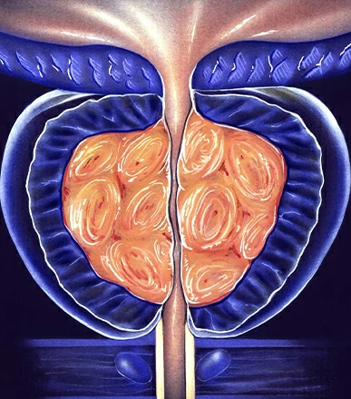 Hiperplasia prostática urólogo Dr. Orlando José Hernández