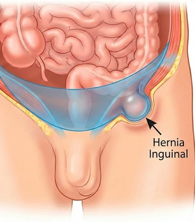 Hernia inguinal
