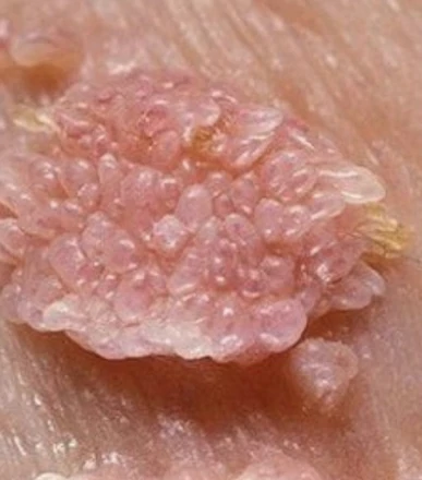 Virus de papiloma humano en hombre