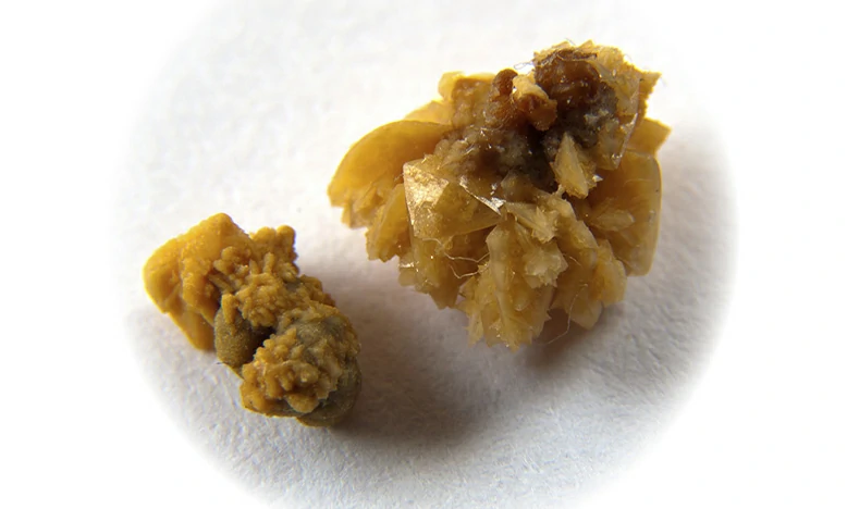 Cálculo renal