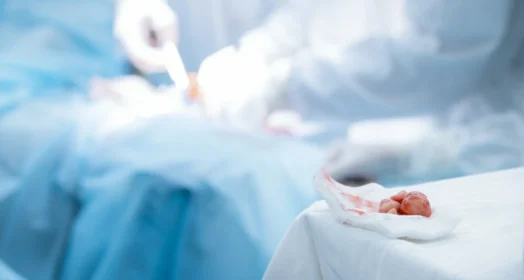 Cirugía láser de cálculos renales