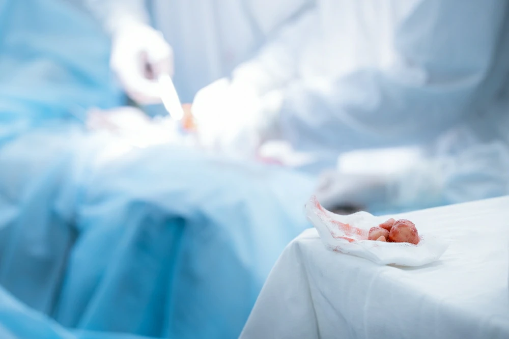 Cirugía láser de cálculos renales