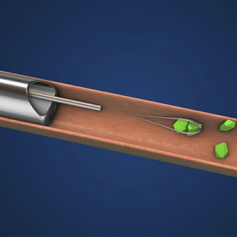 Cirugía de cálculos renales