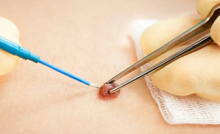 Eliminación de verrugas genitales