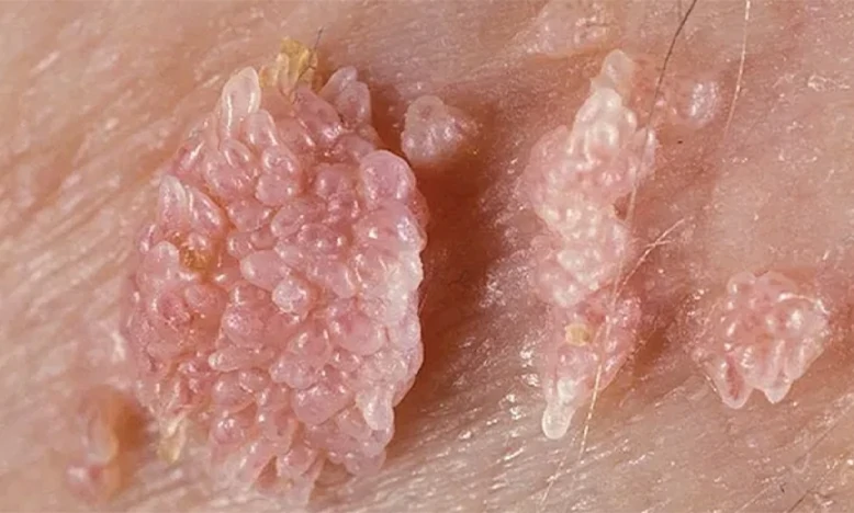 Fulguración de condilomas