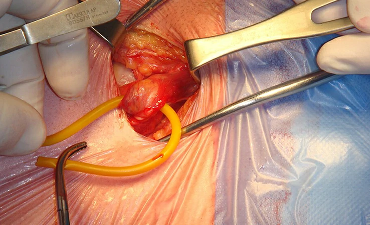 Hernia inguinal urólogo