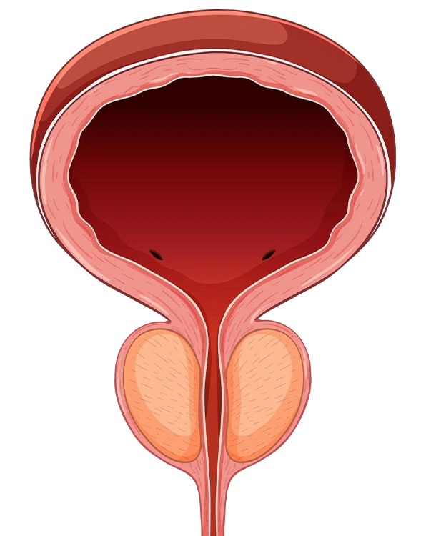 Hiperplasia prostática benigna