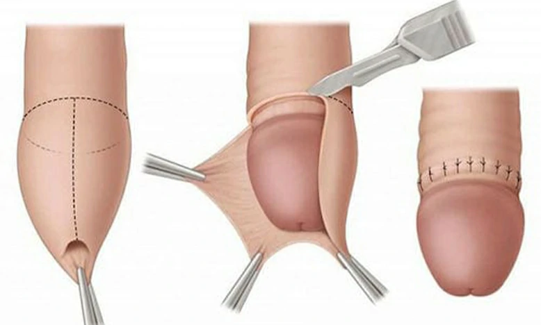 Procedimiento de circuncisión
