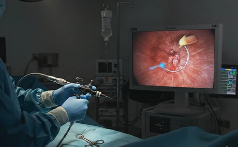 Resección transuretral bipolar de próstata urólogo Dr. Orlando José Hernández