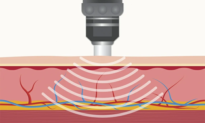 Terapia de ondas de choque