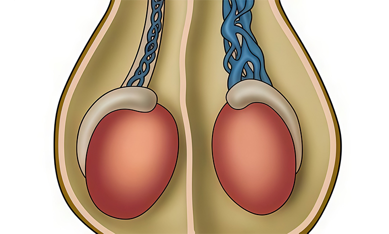 Tratamiento para varicocele