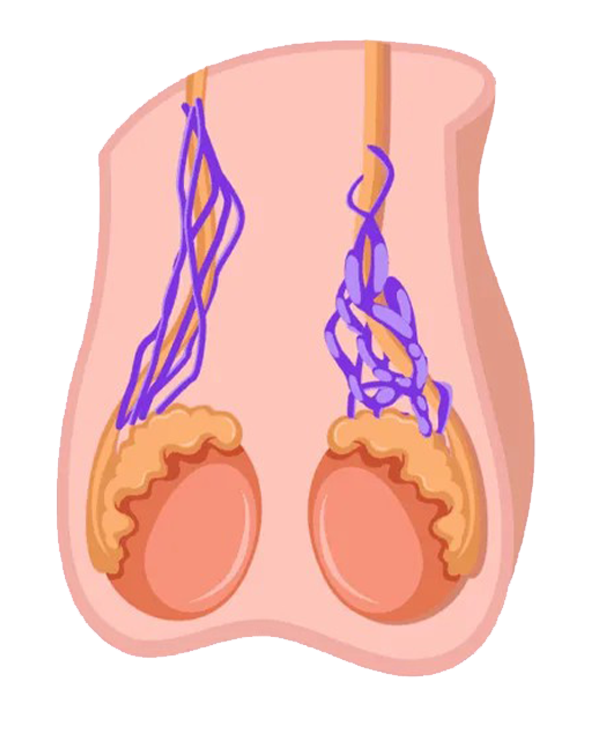 Varicocele