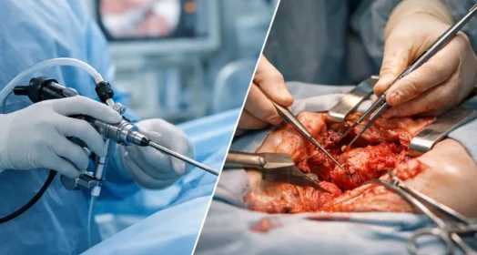 HoLEP vs prostatectomía abierta: qué conviene