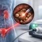 laser para la litiasis urinaria y sus beneficios featured 85x85