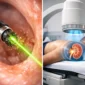 laser ureteral vs litotricia extracorporea featured 85x85
