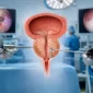 holep versus rtup bipolar cual conviene featured 85x85