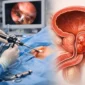 opinion medica sobre la rtup bipolar de prostata featured 85x85