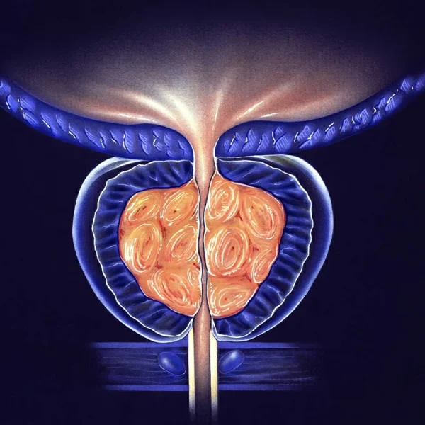 Hiperplasia prostática